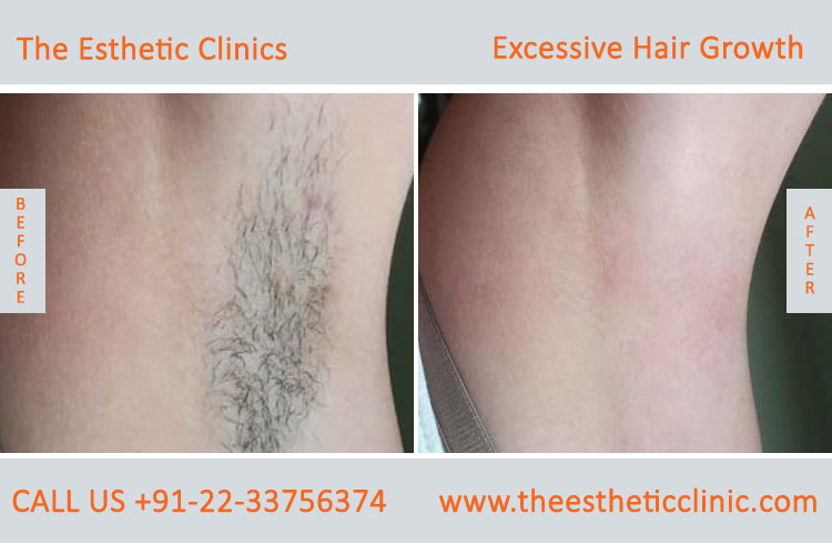 Excessive Hair Growth Removal Treatment before after photos in mumbai india (7)